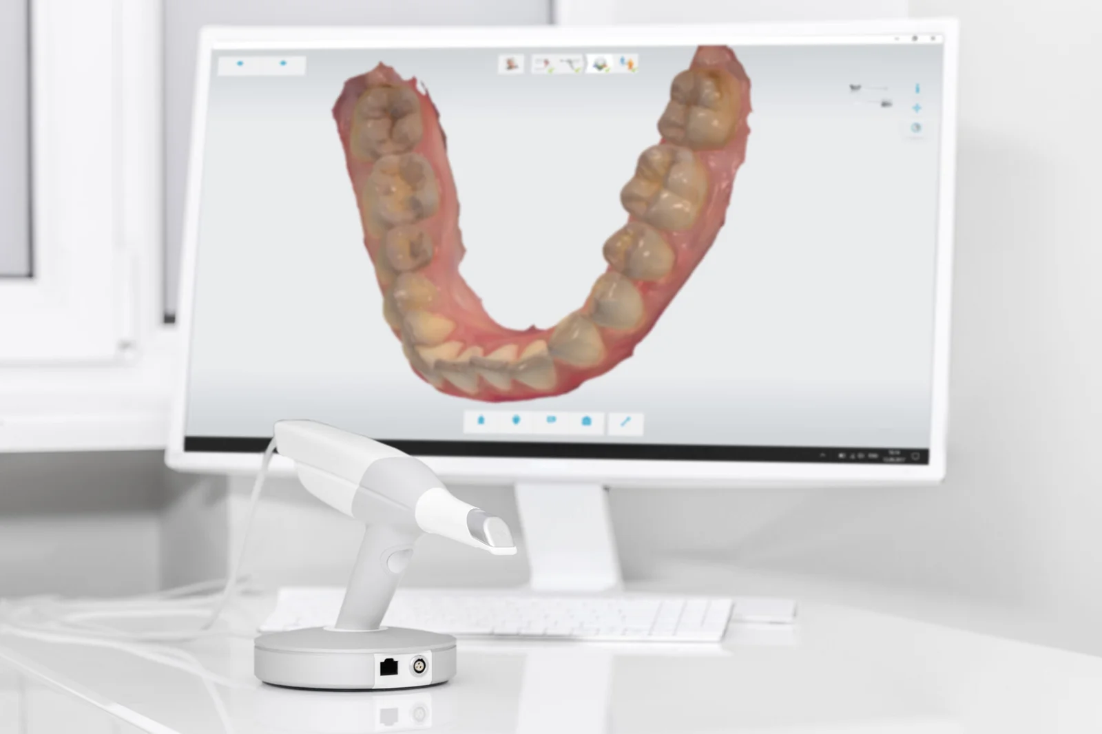 Digital Intraoral Scanner
