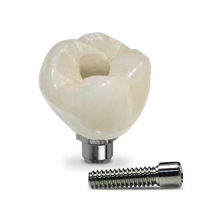 Screw-Retained Crown