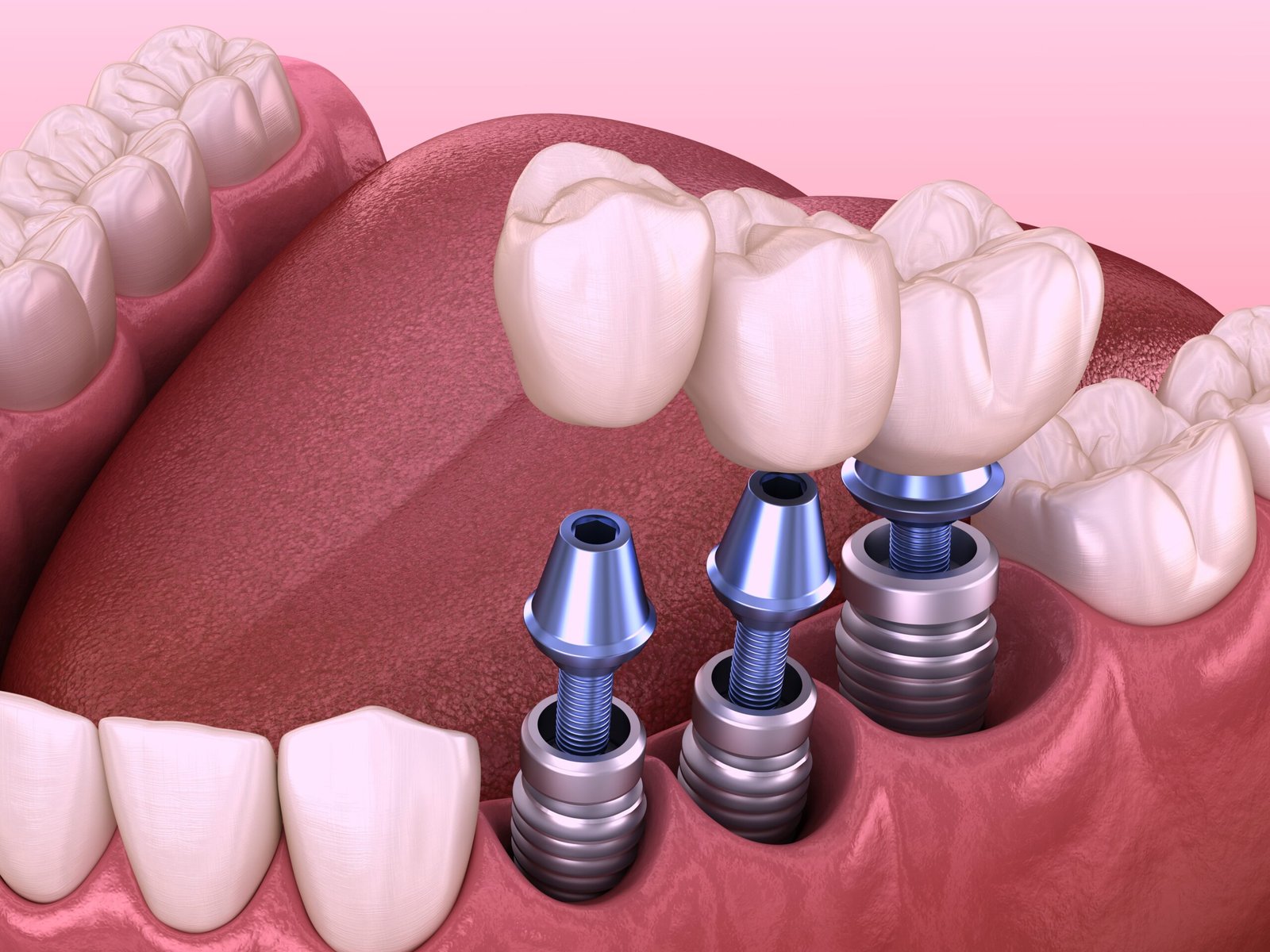 Types of Dental Implant Restorations​
