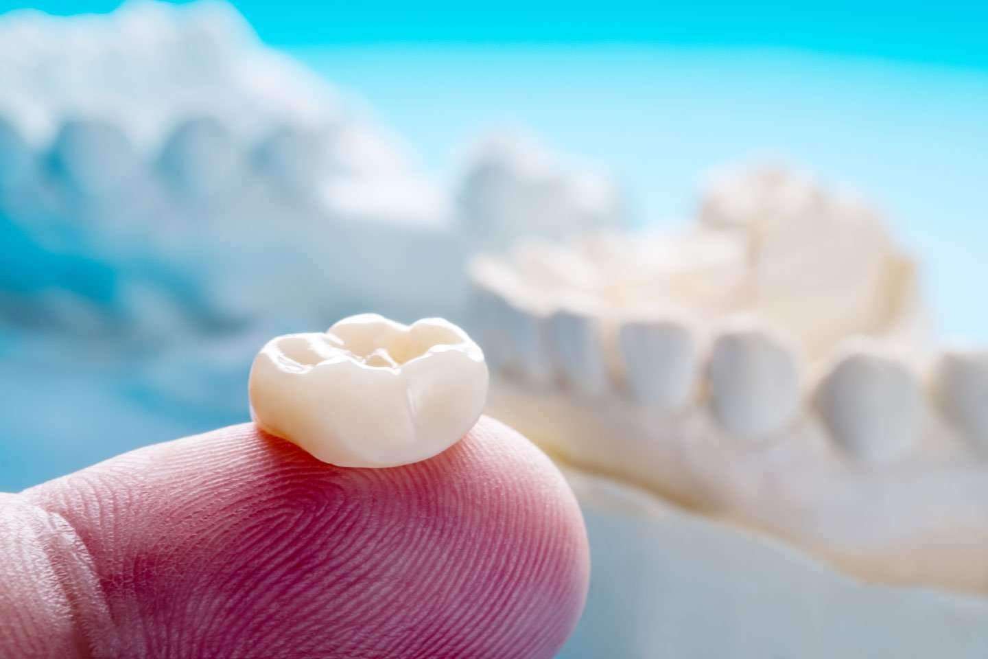 What are Dental Crowns and Bridges?