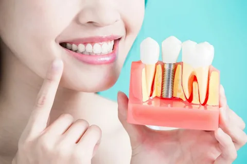 Dental Implants Near You