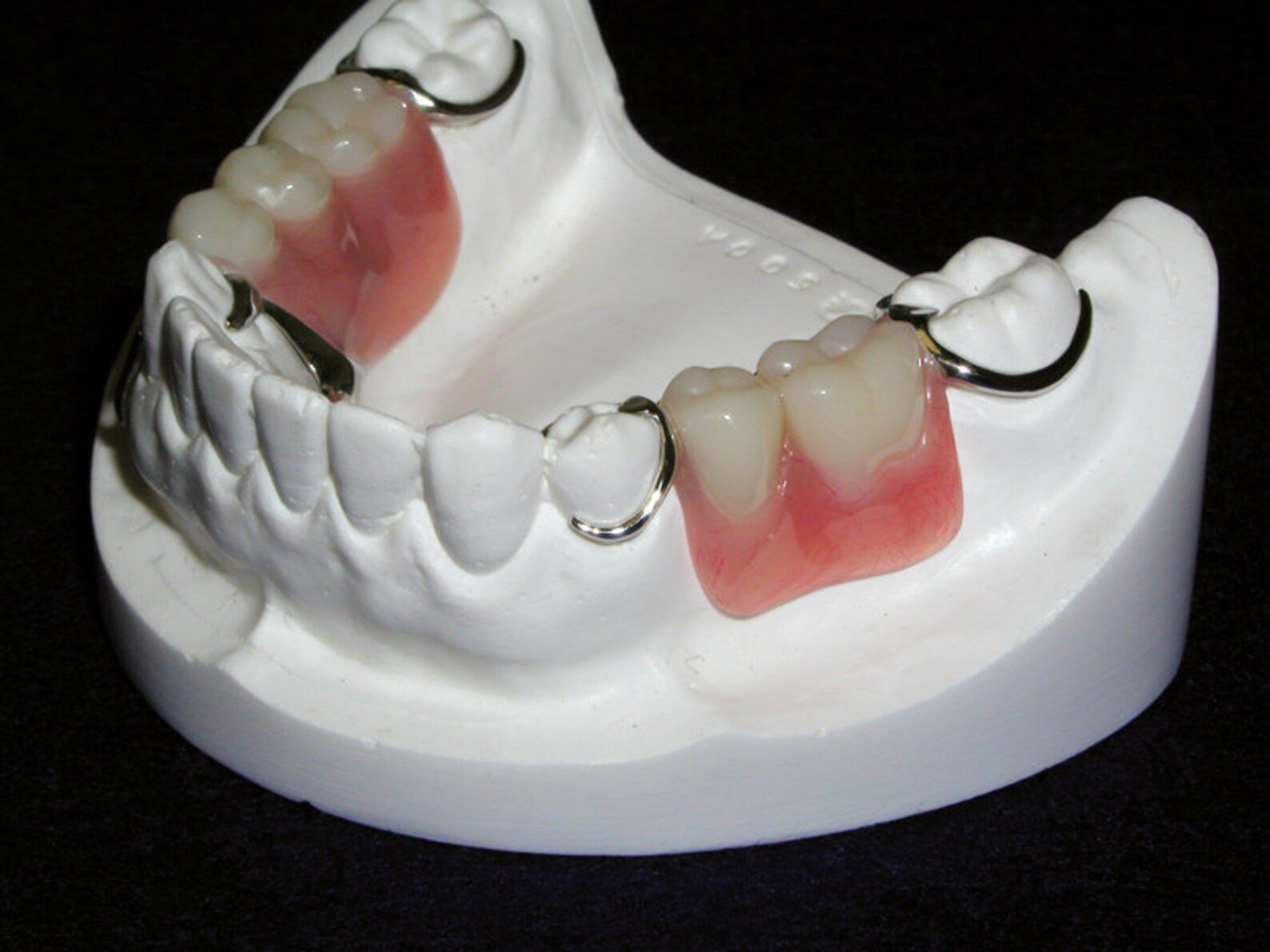 Types of Custom-Made Partial Dentures
