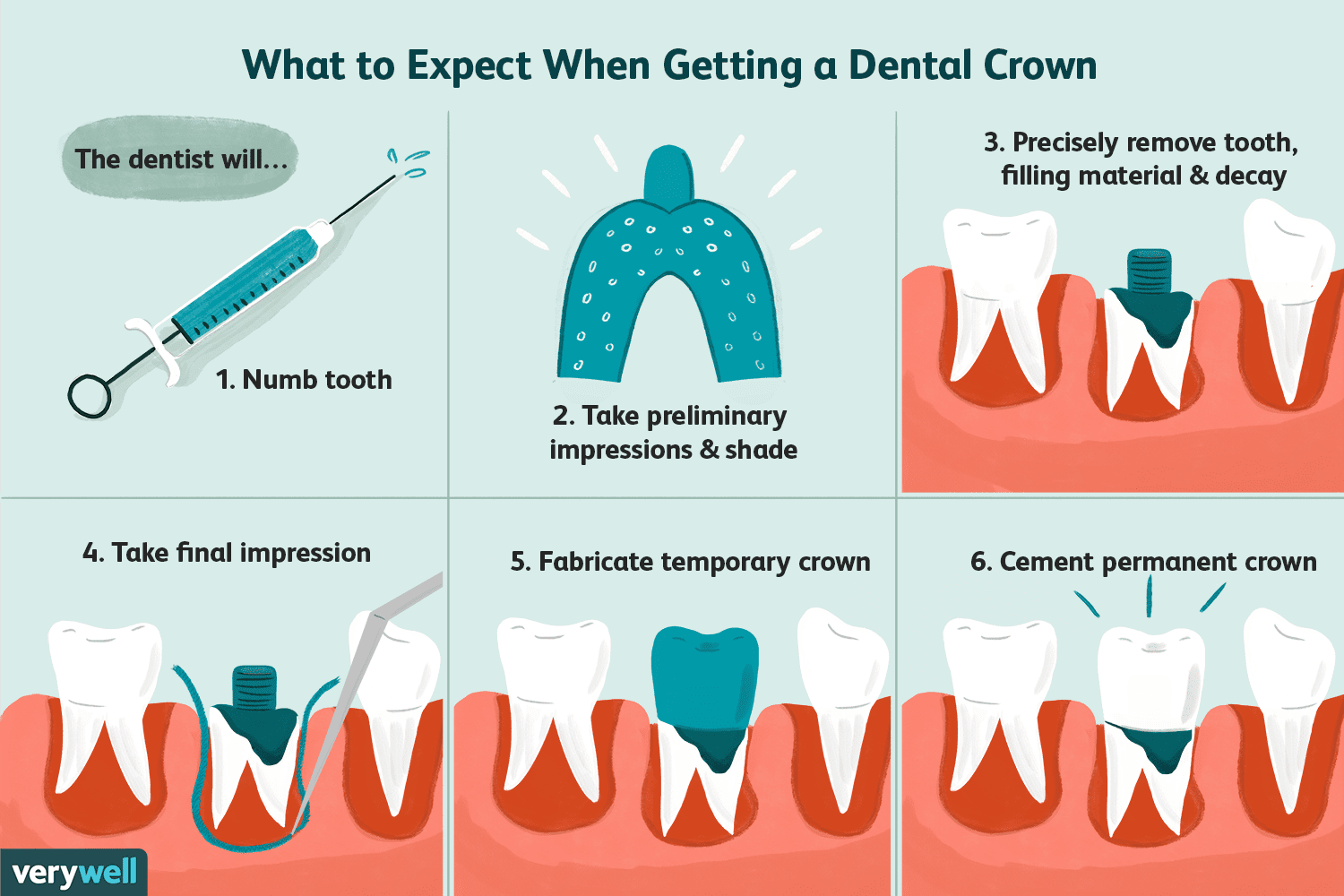 The Custom Crown and Bridge Treatment Process